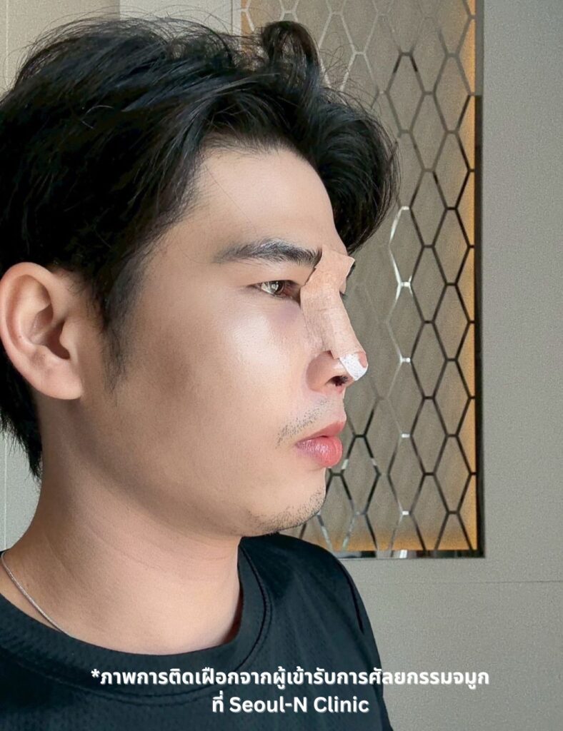 Man turning left side of face with nose splint cover