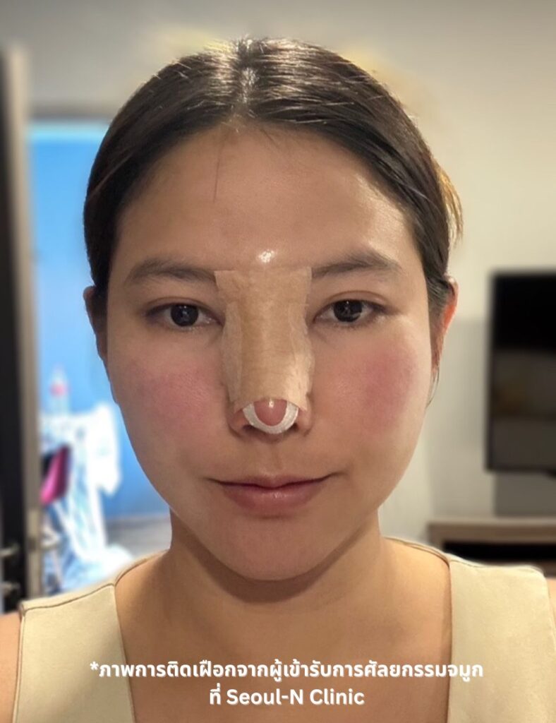 Woman with nose splint cover